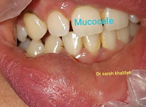 mucocell