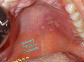 primary herpetic stomatitis