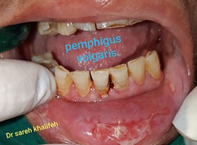 Pemphigus volgaris