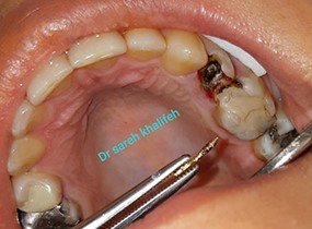 direct post and core crown