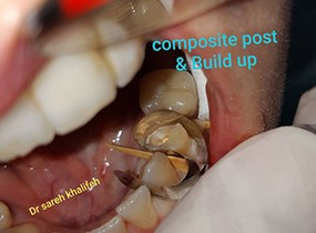 comp post and build up